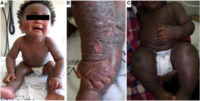 Phenotypes, endotypes and genotypes of atopic dermatitis and allergy in populations of African ancestry on the continent and diaspora